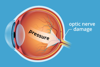 Glaucoma cause