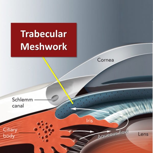 Detailed cause of glaucoma