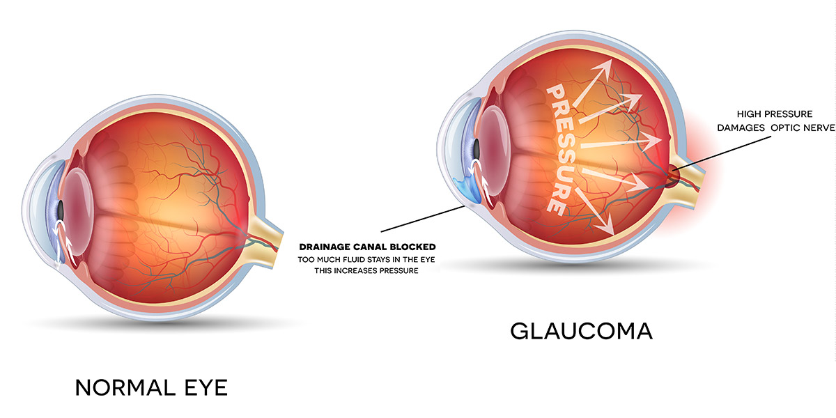 Eye diagram 2